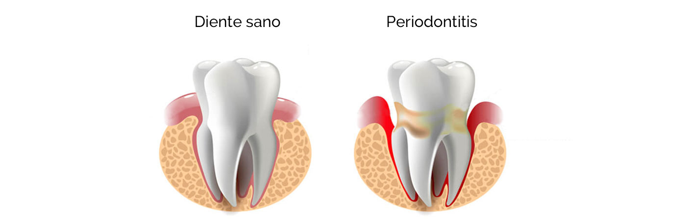 Periodontitis - Enfermedad periodontal