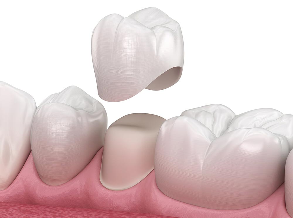 Prótesis dental Coronas